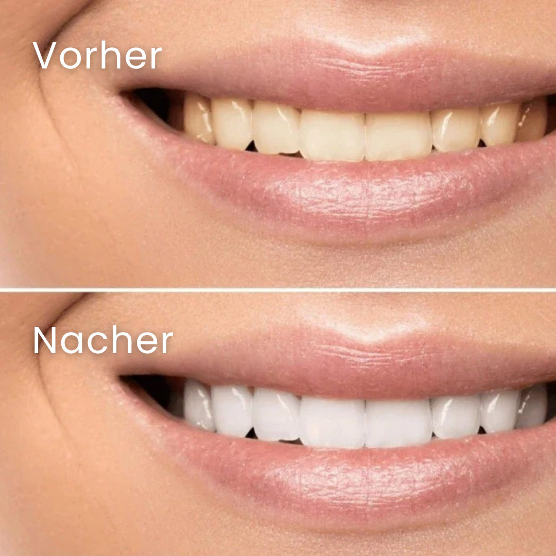 Dental Whitening Strips